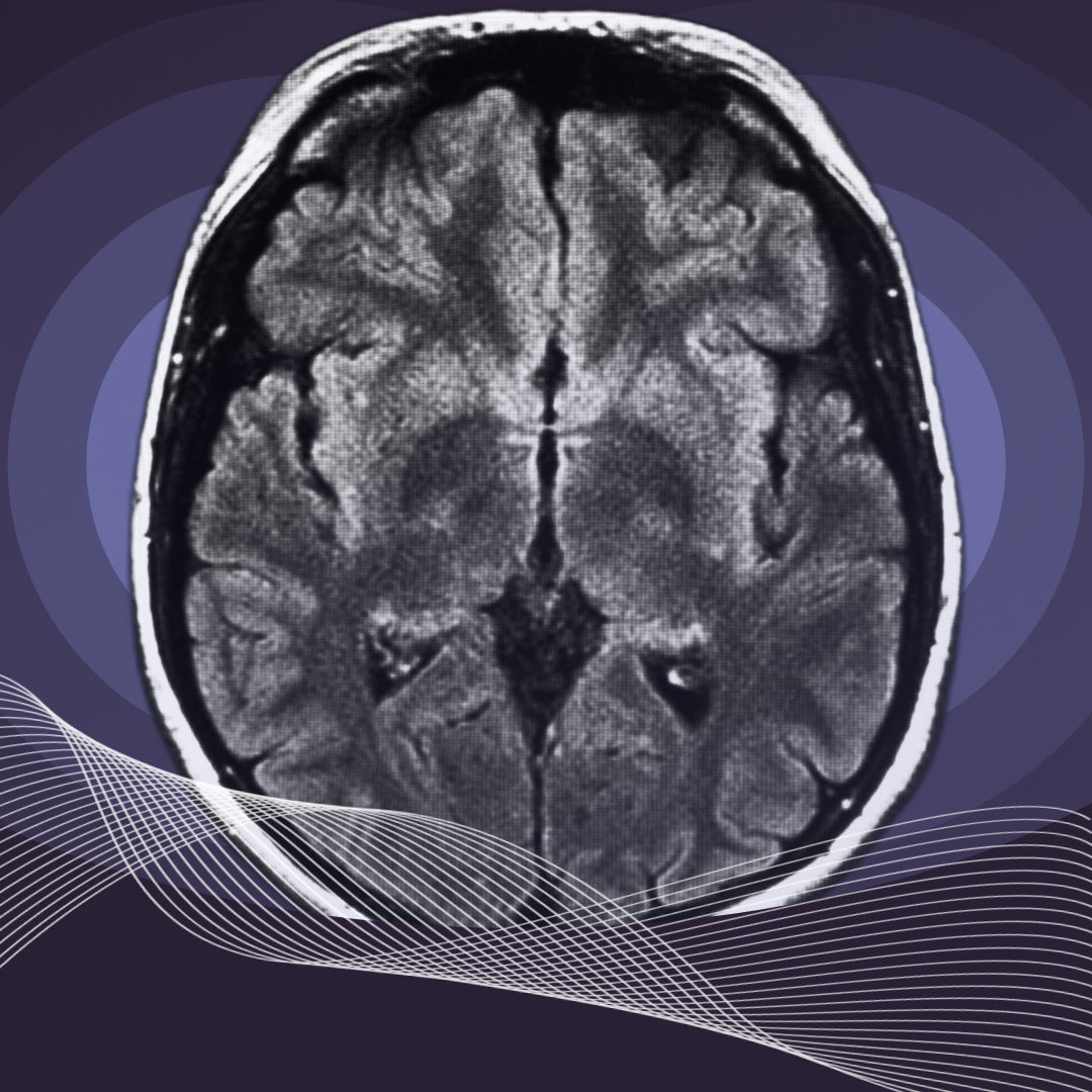 White matter in the brain